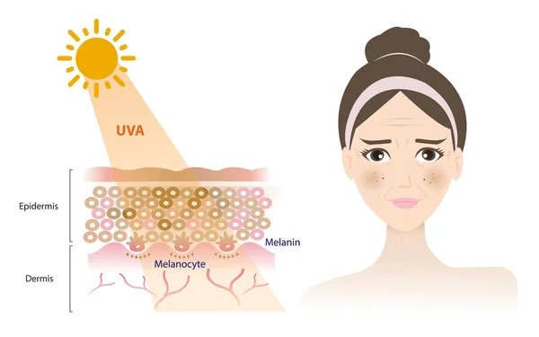 Uva線は真皮の皮膚層に浸透し 女性の顔を損傷し 白の背景に隔離された日焼け メラーマ 暗斑ベクトルをもたらします スキンケアのコンセプトイラスト — ストックベクタ
