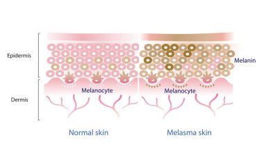 Normal skin layer and melasma skin layer vector, melanocyte, melanin, melanogenesis vector on white background. clipart