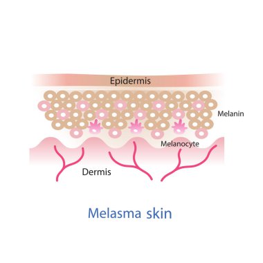  The mechanism of melasma skin vector. Beauty skin care concept illustration.