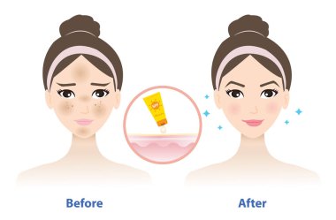 Kullanılmadan önce ve sonra beyaz arkaplanda izole edilmiş güneş kremi vektörü. Kadın yüzü ile melasma karşılaştırması ve yüzüne güneş kremi sürmenin daha iyi bir sonucu. Cilt bakımı ve güzellik konsepti çizimi.