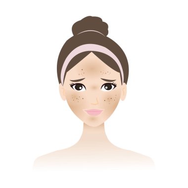 Hiperpigmentasyon ve melasyon beyaz arka planda izole edilmiş kadın yüz vektöründe. Yüzünde, yanaklarında, burnunda, üst dudağında ve alnında lekeler var. Cilt problemi çizimi.