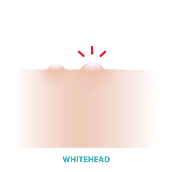 Ilustração Vetor Acne Whitehead Isolado Fundo Branco Formação Comedona Cabeça — Vetor de Stock