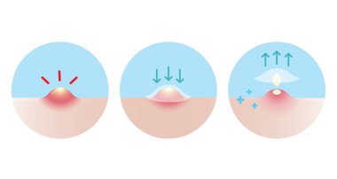İltihaplı akne vektör ikonu için sivilce yaması kullanma yönü beyaz arkaplanda resimleme ayarlandı. Nasıl kullanılacağını, sivilce yamasını nasıl kullanacağını cilt yüzeyindeki kabarcıkları nasıl emeceğini. Cilt bakımı ve güzellik kavramı.