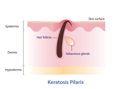Keratosis Pilaris. Ingrown hair, Chicken skin vector illustration isolated on white background. Hair has grown back into the skin surface. Bumpy skin that looks like tiny pinpricks or goosebumps. Atopic Dermatitis Infographic. clipart