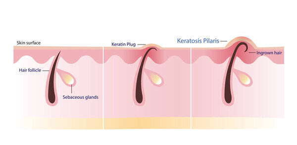 Процесс векторной иллюстрации кератоза Pilaris изолирован на белом фоне. Поперечное сечение Кератинового штепселя, Вросшие волосы, Куриная кожа и Неровная кожа. Инфографика атопического дерматита.