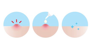 Akne sivilce tedavisinin iltihaplı akne vektör ikonu için beyaz arka planda nasıl kullanılacağını. Kullanım adımı, akne kremi, jel ve losyon kullanma yönü cilt yüzeyinde papüle emme. Cilt bakımı ve güzellik kavramı.