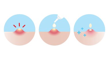 Akne sivilce tedavisi için yön, iltihaplı akne vektör ikonu beyaz arka planda gösterilmiştir. Nasıl kullanılacağını, sivilce kremi, jöle ve cilt kabarcığını nasıl emeceğini. Cilt bakımı ve güzellik kavramı.
