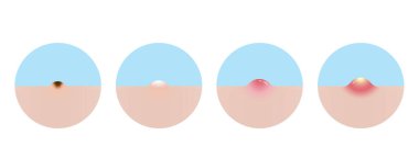 Akne vektör simgesi tipleri beyaz arkaplanda izole edilmiş resimleme seti. Sivilce, siyah nokta, beyaz kafa, papüle ve sivilce oluşumu. Düz tasarım vektör akne illüstrasyonu. Cilt bakımı ve güzellik kavramı.