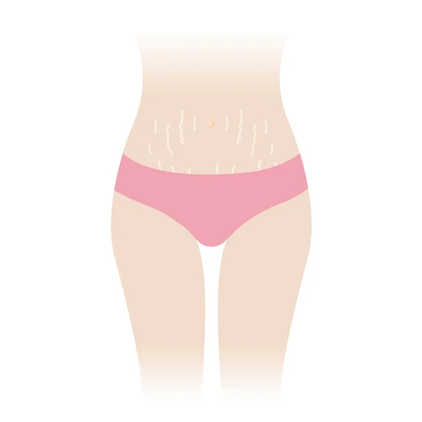 Stretch Marks Tummy Vector Illustration Isolated White Background White Stretch — Stock Vector