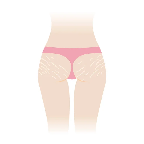 Stretch Marks Buttocks Vector Illustration Isolated White Background White Stretch — Vettoriale Stock