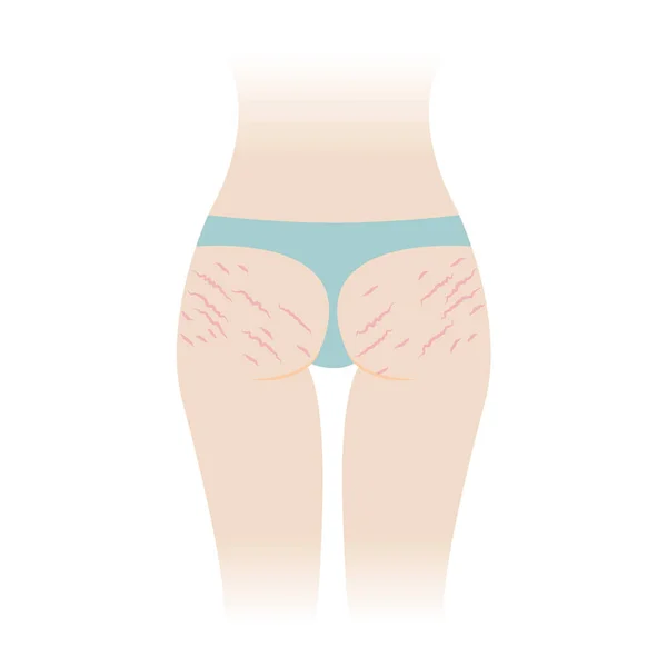 Red Stretch Marks Buttocks Vector Illustration Isolated White Background Striae — Vector de stock