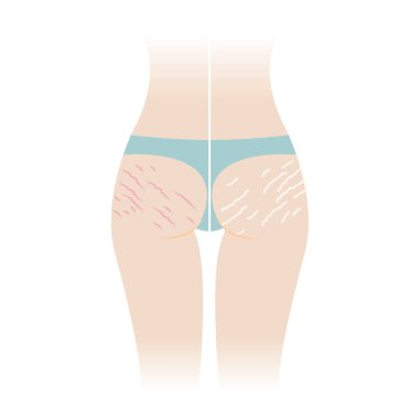 Comparison of red and white stretch marks on buttocks vector illustration isolated on white background. The striae rubrae and striae albae appear on the bottom, hip, ass back of woman body. Skin care and beauty concept. clipart