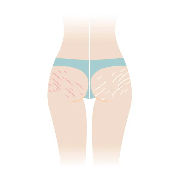 Comparison Red White Stretch Marks Buttocks Vector Illustration Isolated White — ストックベクタ