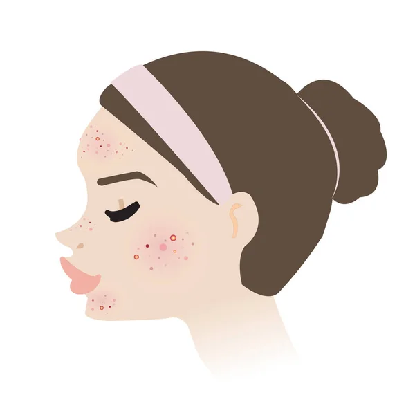 女性面对粉刺皮肤侧面视线向量分离的白色背景 脸上有粉刺 粉刺和脓包 不发炎和不发炎痤疮 皮肤面部问题概念说明 — 图库矢量图片