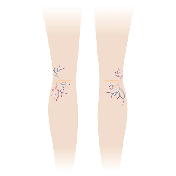 女性の脚のヴァリコース静脈とクモの静脈 白い背景で隔離されたベクターのイラスト ヴァリコースおよびクモの静脈は腫れ より大きくなるねじれ それらが皮の下で示すようにします — ストックベクタ