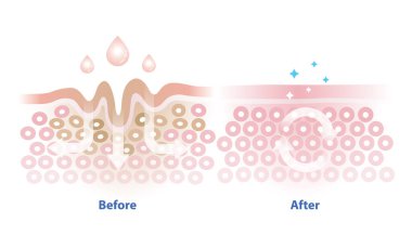 Cilt soğurma vektör illüstrasyonundan önce ve sonra beyaz arka planda izole edildi. Cilt ve cilt kırışıklıklarının çapraz kesimi yaşlanmayı ve zarar görmüş deriyi azaltmaya yardımcı olur. Cilt bakımı kavramı.
