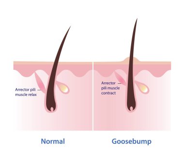 Beyaz arka planda izole edilmiş deri vektör illüstrasyonundaki tüyler diken diken oldu. Normal cilt karşılaştırması, arrektör pili kas gevşemesi ve tüyler ürperti, arrektör pili kas kasılması ve düz saç çekin.