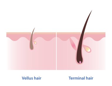 The difference between vellus hair and terminal hair vector illustration isolated on white background. Hair Types. Vellus hair is fine, wispy and unpigmented hair. Terminal hair is thick, coarse, long and pigmented hair. clipart