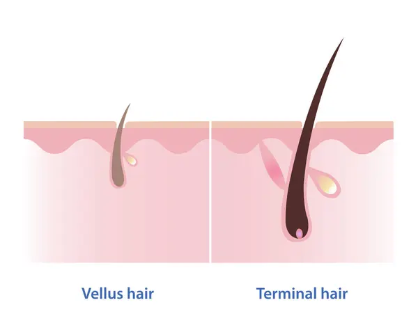 Difference Vellus Hair Terminal Hair Vector Illustration Isolated White Background — Stock Vector