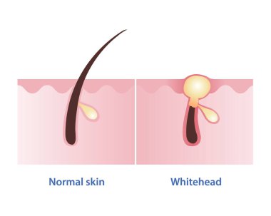 Normal skin and whitehead acne vector illustration isolated on white background. Whitehead, type of non inflammatory pimple. Closed comedone. Skin care and beauty concept. clipart