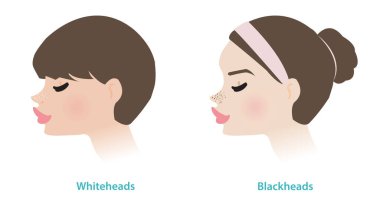 Cute women with whiteheads and blackheads acne on noses vector illustration. Whiteheads and blackheads are both types of non inflammatory acne, they are forms of comedones. The pore is closed or open. clipart