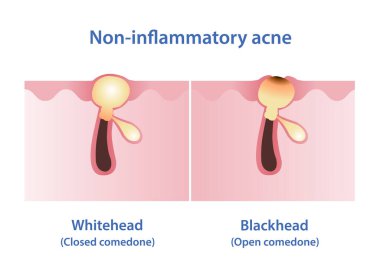 Whitehead ve blackhead akne vektör çizimi arasındaki fark. Kır Saçlı ve Siyah Nokta iltihaplı olmayan sivilcelerin her ikisi de bir tür komedi türü. Gözenek kapalı ya da açık.