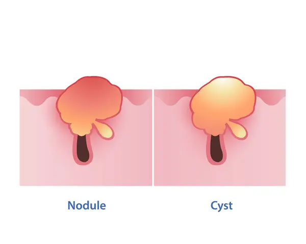 Het Verschil Tussen Nodule Cyste Vector Witte Achtergrond Nodular Stevig Stockillustratie