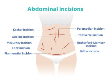 Types of abdominal incision for surgery vector illustration isolated on white background. Kocher, Midline, McBurney, Lanz, Pfannenstiel, Paramedian, Transverse, Rutherford Morrison, Battle incision. clipart