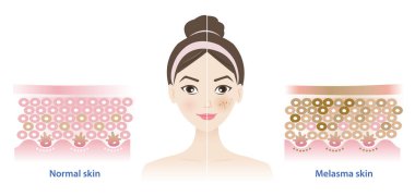 Beyaz arka planda normal ve melasma derisi ile kadın yüz vektör çizimi karşılaştırması. Sağlıklı üst deri tabakası, melasyon ve koyu lekelerin diyagramı. Cilt bakımı ve güzellik kavramı.
