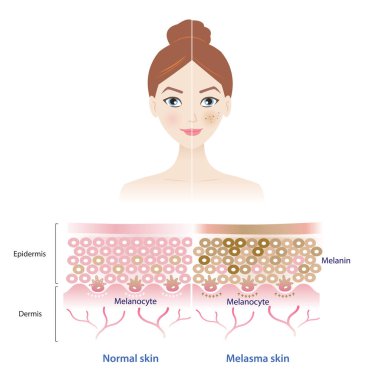 Infographic of normal and melasma skin on woman face vector illustration. Comparison of healthy epidermis skin layer, hyperpigmentation, melasma and dark spots. Skin care and beauty concept. clipart