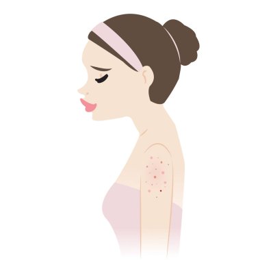 Üst kol vektör illüstrasyonunda sivilceli kadın beyaz arka planda izole edilmiş. Sivilceler, sivilceler, siyah noktalar, beyaz başlıklar, papüle, sivilce, nodül ve kist. Cilt problemi kavramı.