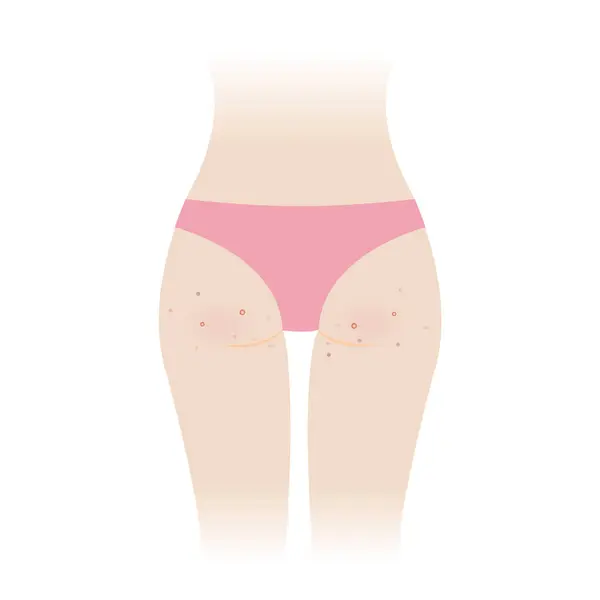 Acne Woman Buttocks Vector Illustration Isolated White Background Pimples Comedone Vectorbeelden