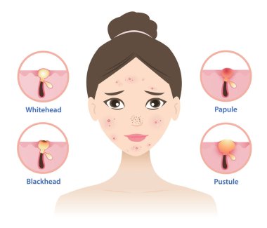 Beyaz arka planda izole edilmiş kadın yüz vektör illüstrasyonundaki sivilce türleri. Sivilce, akbaş, siyah nokta, papüle ve sivilce ikonu. Cilt bakımı ve güzellik kavramı.
