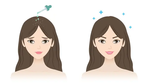 Stock vector Before and after anti dandruff treatment vector illustration isolated on white background. The woman with dandruff, white dry flakes, scaly scalp and healthy hair. Hair care and problem concept.