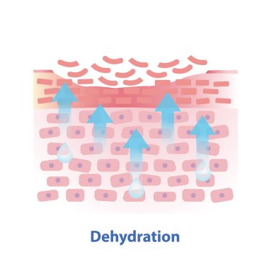 Susuz bırakma deri vektör çizimi mekanizması. Kuru deri bariyerinin çapraz kesimi daha fazla suya yol açar ve üst tabakada su eksikliği yaratır. Cilt bakımı ve güzellik kavramı.