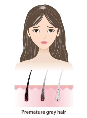 The woman with premature gray hair vector illustration isolated on white background. The mechanism of hair graying with scalp layer. Hair anatomy, hair structure and hair care concept. clipart