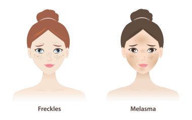 Çilli ve cilt yüzeyinde melasyon olan kadınlar beyaz arka planda izole edilmiş. Pigmentasyon türleri, Çiller, Ephelides, Güneş Mercekleri, Aktinik mercimek ve melasma.