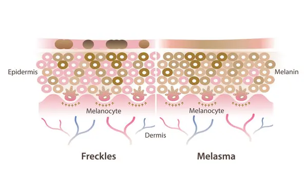 stock vector Cross section of freckles and melasma on skin layer vector illustration isolated on white background. Comparison of freckles are small flat brown spots and melasma is brown, blue gray patches on skin.