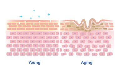 Beyaz arka planda genç ve yaşlanan deri vektör çizimlerinin karşılaştırılması. Yapı katmanında güç, esneklik ve dayanıklılık kaybeden sağlıklı ve kırışıklıkların kesiştiği bölge..
