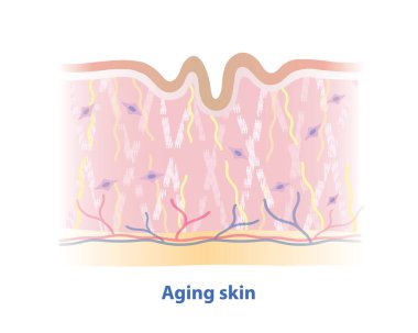 Kırık kolajen, elastin lifler ve küçültülmüş fibroblastlar, beyaz arka planda izole edilmiş yaşlanan deri katmanı vektör çizimi. Buruşuk deri oluşumu, güç kaybı, esneklik, sertlik..