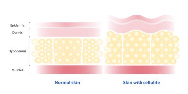 Comparison of normal skin and skin with cellulite vector illustration isolated on white background. The fat cells enlarged, connective tissue stretched. The skin dimpling, looks like orange peel. clipart