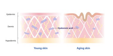 Hyaluronik asit seviyeleri, deri vektör illüstrasyonundaki yaşla karşılaştırıldığında azalır. Genç ve yaşlanan deri ile hiyalüronik asit molekülünün kesiştiği yer. Cilt bakımı ve güzellik kavramı.