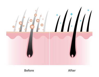 Beyaz arka planda izole edilmiş kafa derisi katmanı vektör illüstrasyonlu gri saç kaplama şampuanı mekanizması öncesi ve sonrası. Renkli şampuan, bitkisel renk serumu, saç bakım konsepti çizimi.