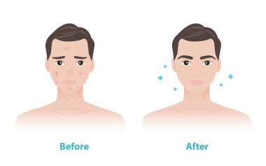 Sivilce tedavi vektörü illüstrasyonundan önce ve sonra insan yüzü karşılaştırması. Erkeklerde iltihaplı sivilceler, siyah noktalar, beyaz başlıklar, papüle, sivilce, yara. Erkekler cilt bakımı kavramı.