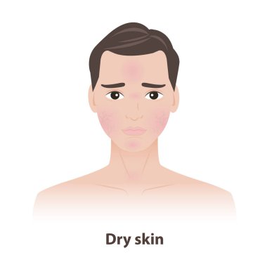 The man with dry skin on face illustration. Caused by heat, sunshine, stress and environmental variables, lead to dryness, dehydration, itching, irritation and cracking of skin. Men skin care concept. clipart