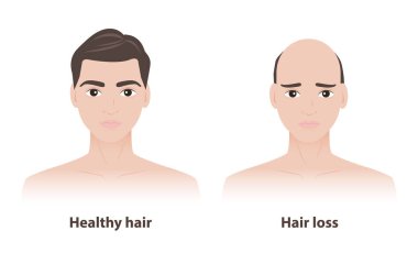 Beyaz arka planda sağlıklı saçlı ve saç dökülmesi olan iki adamın karşılaştırılması. Kalın ve güçlü saçları olan adam, diğerinin saçları daha ince, androgenetik alopecia..