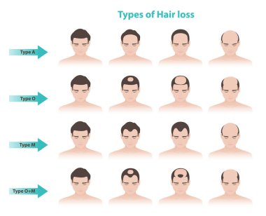 Beyaz arka planda izole edilmiş erkek vektör illüstrasyonundaki saç kaybı türleri. Erkek şablonu kelliğinin ya da androgenetik alopezinin bilgi aşamaları. Saç bakımı ve sorun konsepti.