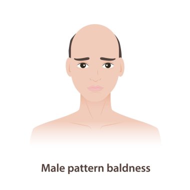 Erkek desenli kellik beyaz arka plandaki erkek illüstrasyonunda görülen saç sorunlarıdır. Androgenetik alopecia, genellikle genetik ve hormon dihidrotestosteron olan DHT 'den kaynaklanan bir saç dökülmesidir..