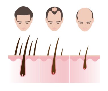 Beyaz arka planda izole edilmiş erkek desenli saç kaybı vektör çizimi. Kafa derisi yüzme anatomisi yüzünden saçı dökülen adam. Androgenetik alopecia, erkek modeli kellik..