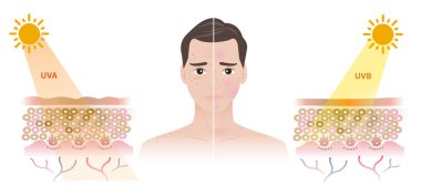 UVA ve UVB ışınlarından kaynaklanan hasarlı yüz karşılaştırması. UVA çillere, yaşlanmaya, kırışıklıklara ve koyu lekelere neden olur. UVB yanığa, iltihaplanmaya ve kırmızı noktalara neden olur. Erkekler cilt bakımı kavramı.
